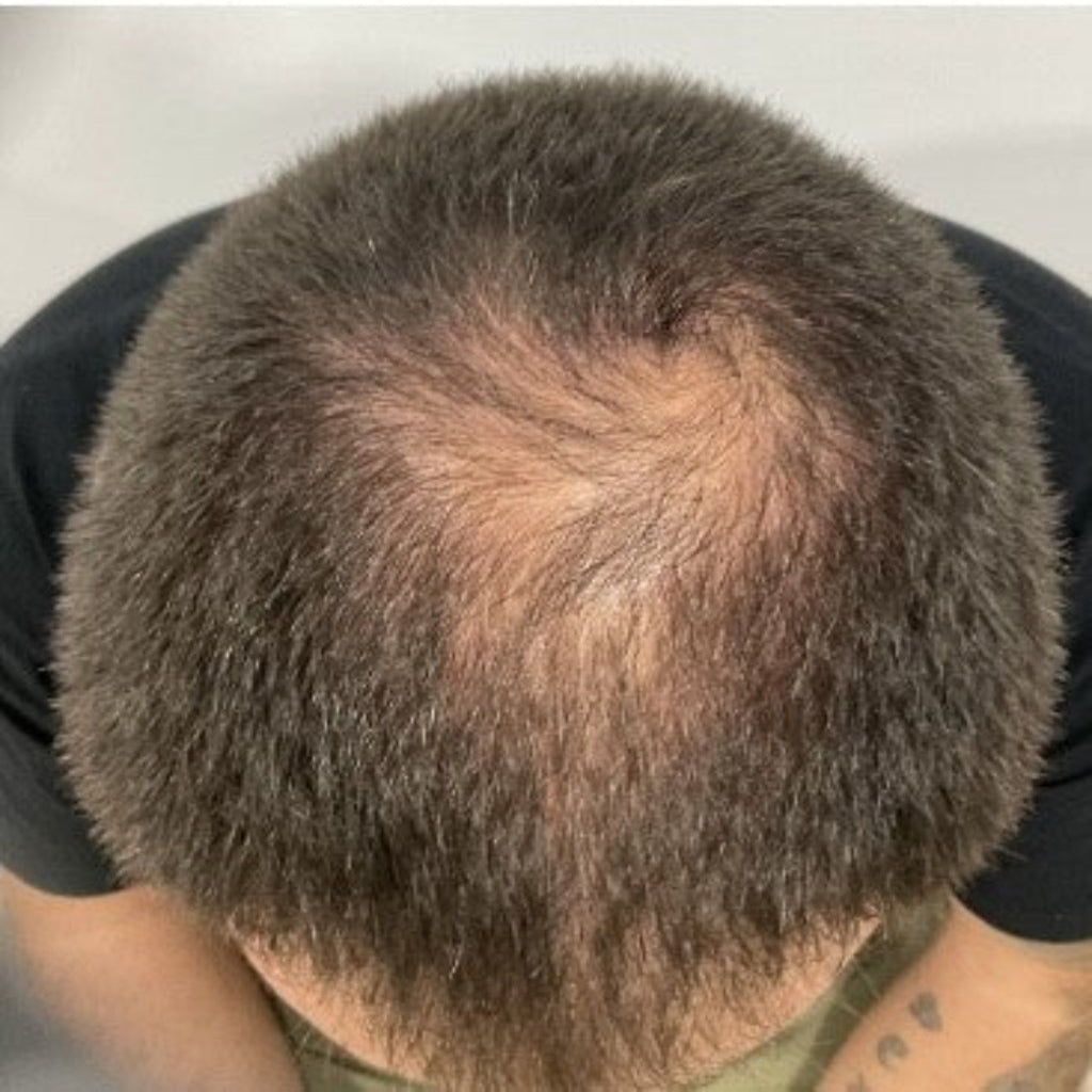 APEXCAPILARE_BEFORE_HAIR_REGROW