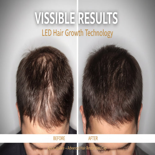 Red light therapy hair growth device — 630-670nm LED wavelength